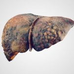 liver disease