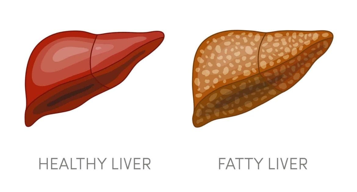 Planning Your Fatty Liver Diet Plan | Fatty Liver Guide