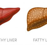 fatty liver diet