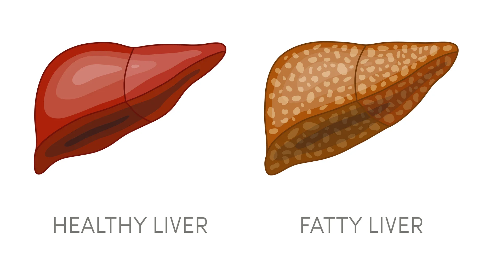 fatty liver diet