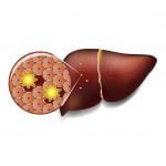 reverse fatty liver