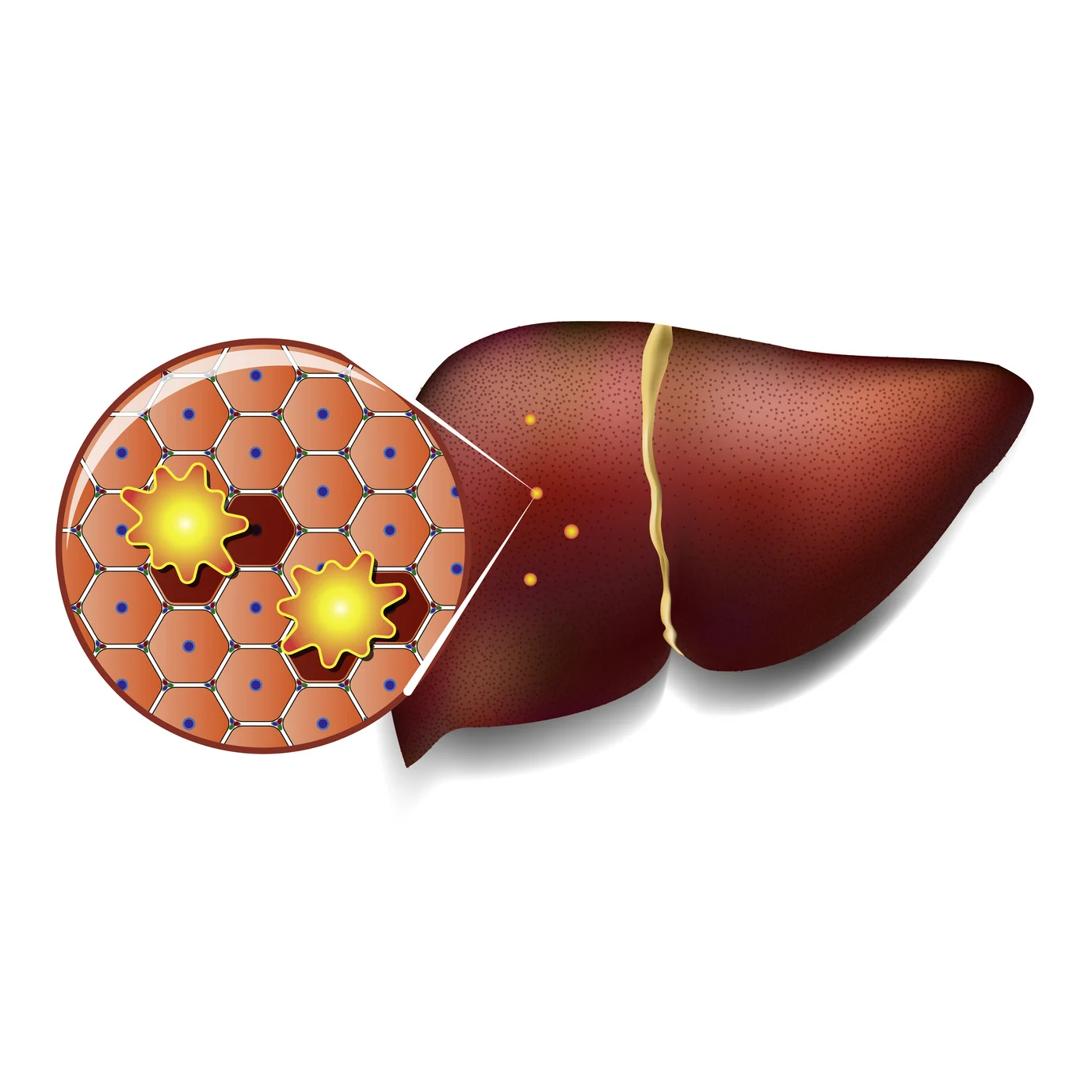 reverse fatty liver