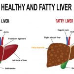 fatty liver