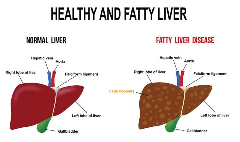 fatty liver