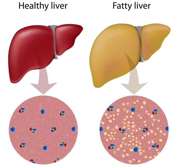 fatty liver