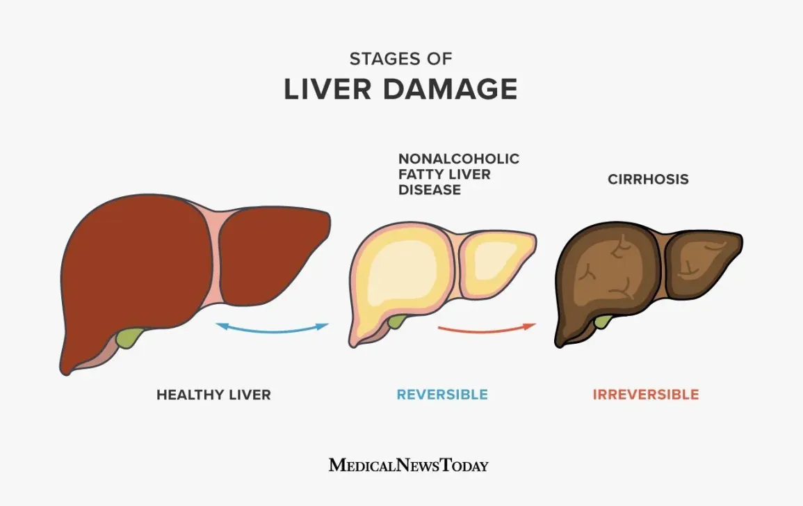NASH Reversal: Reclaiming Your Liver Health