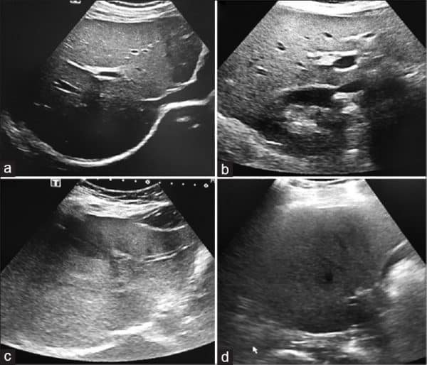 Understanding Fatty Liver Ultrasound Grading Fatty Liver Guide 5920