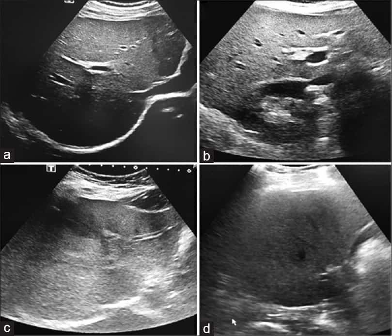 Understanding Fatty Liver Ultrasound Grading