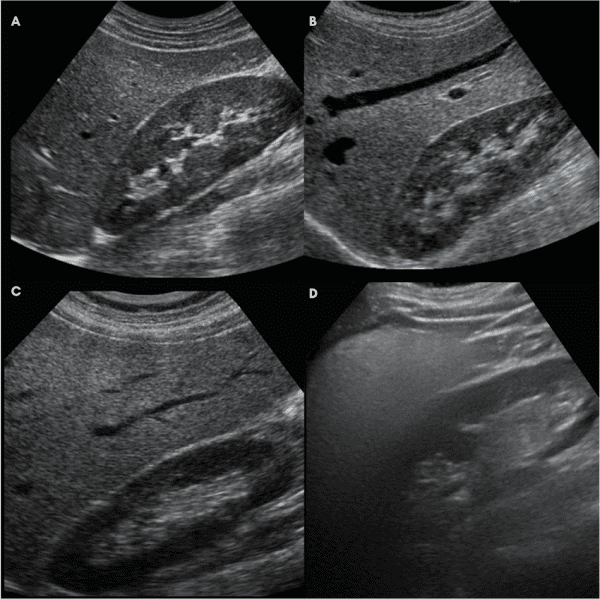 Understanding Fatty Liver Ultrasound Grading | Fatty Liver Guide