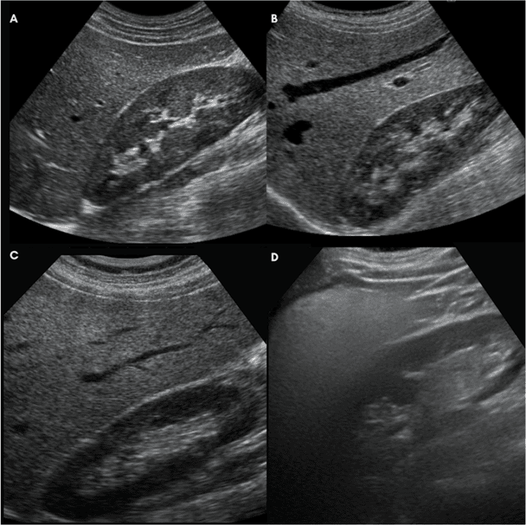 Understanding Fatty Liver Ultrasound Grading | Fatty Liver Guide