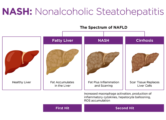 Understanding NASH Life Expectancy