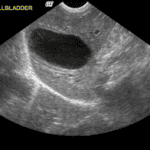  echotexture of liver