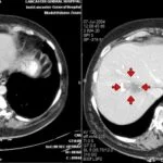  fatty liver ct scan