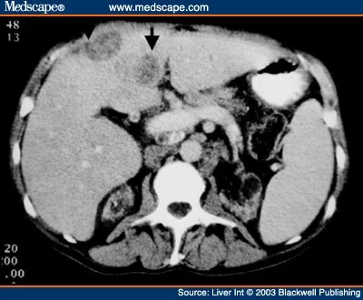  hyperechoic liver