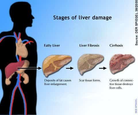  life expectancy with fatty liver disease
