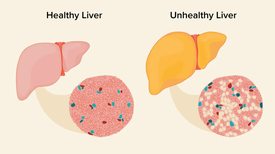 Fatty Liver: The Silent Epidemic and How to Fight Back